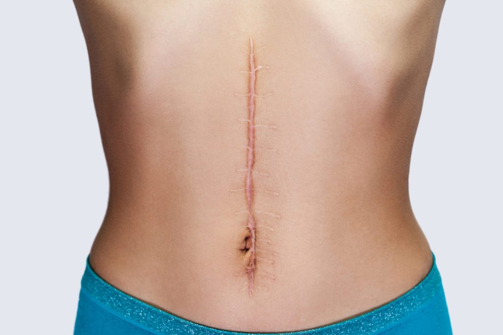 Scar revision surgery